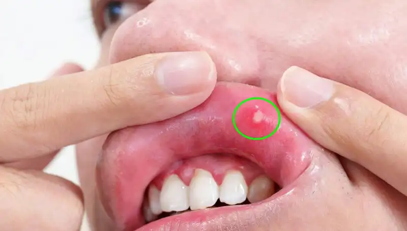Kanserin Sessiz Belirtilerini Göz Ardı Edenler İçin Şok Edici Hikaye