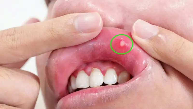 B Vitamini Eksikliği: Vücudunuzun Gizli Belirtilerini Keşfedin