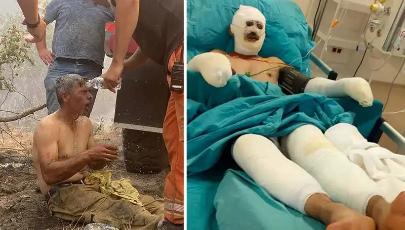 Yangından Kaçarken Yanıklar İçinde Kalan Orman İşçisinin Hayata Tutunma Mücadelesi